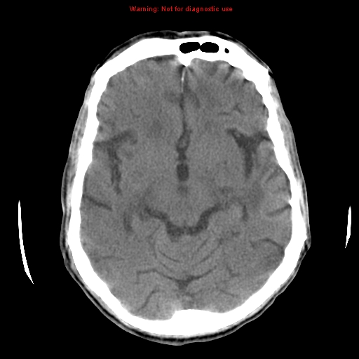 File:Cerebral and orbital tuberculomas (Radiopaedia 13308-13310 Axial non-contrast 12).jpg