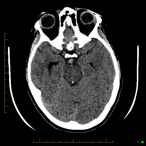 Cerebral arteriovenous malformation (AVM) (Radiopaedia 78162-90706 Axial non-contrast 24).jpg