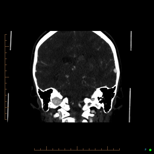 Cerebral arteriovenous malformation (AVM) (Radiopaedia 78162-90706 Coronal CTA 43).jpg