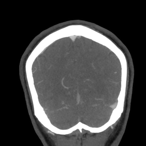 Cerebral arteriovenous malformation (Radiopaedia 39259-41505 E 57).png
