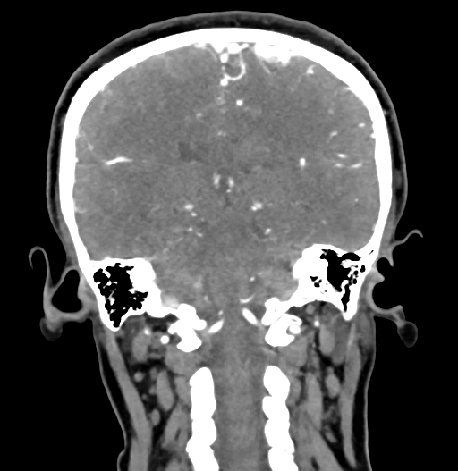 Cerebral arteriovenous malformation (Radiopaedia 73830-84645 C 62).jpg