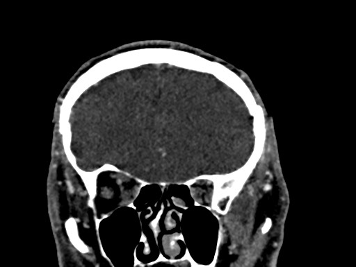 File:Cerebral arteriovenous malformation (Radiopaedia 78188-90746 Coronal C+ delayed 25).jpg