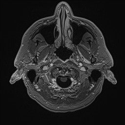 Cerebral arteriovenous malformation (Radiopaedia 84015-99245 Axial T1 C+ 19).jpg