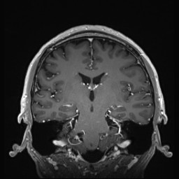 Cerebral arteriovenous malformation (Radiopaedia 84015-99245 Coronal T1 C+ 86).jpg