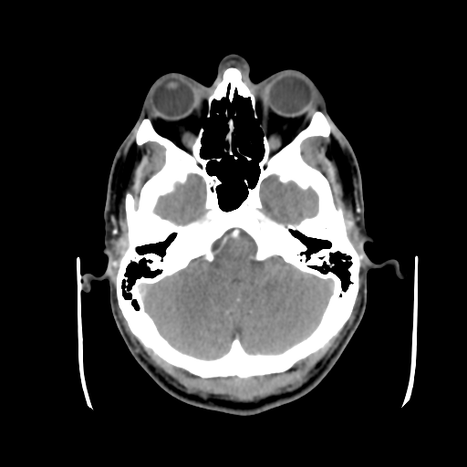 Cerebral arteriovenous malformation (Spetzler-Martin grade 2) (Radiopaedia 41262-44076 Axial C+ 11).png