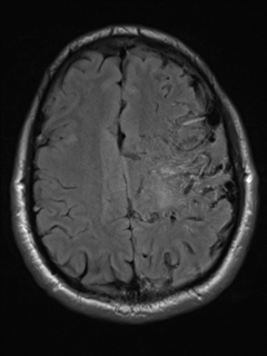 File:Cerebral arteriovenous malformation - huge (Radiopaedia 35734-37272 Axial FLAIR 17).png