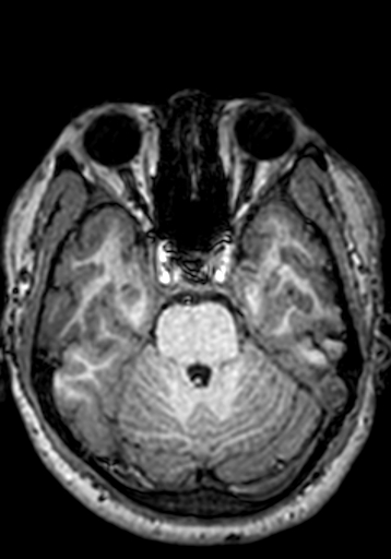 File:Cerebral arteriovenous malformation at posterior body of corpus callosum (Radiopaedia 74111-84925 Axial T1 216).jpg