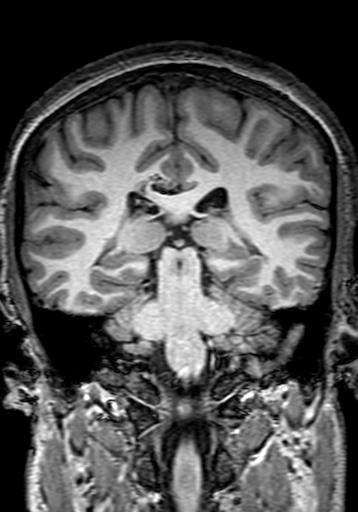Cerebral arteriovenous malformation at posterior body of corpus callosum (Radiopaedia 74111-84925 Coronal T1 208).jpg