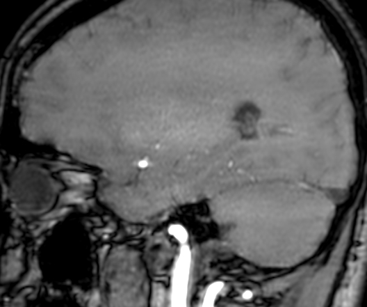 Cerebral arteriovenous malformation at posterior body of corpus callosum (Radiopaedia 74111-84925 J 275).jpg