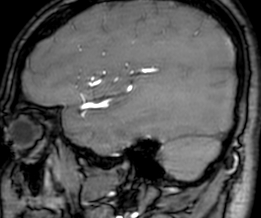 Cerebral arteriovenous malformation at posterior body of corpus callosum (Radiopaedia 74111-84925 J 74).jpg