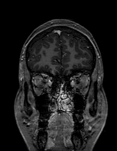 Cerebral arteriovenous malformation at posterior body of corpus callosum (Radiopaedia 74111-84925 K 53).jpg