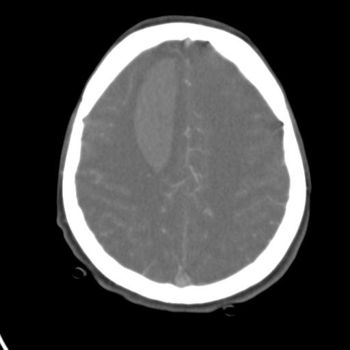 Cerebral arteriovenous malformation with hemorrhage (Radiopaedia 28773-29073 A 16).jpg