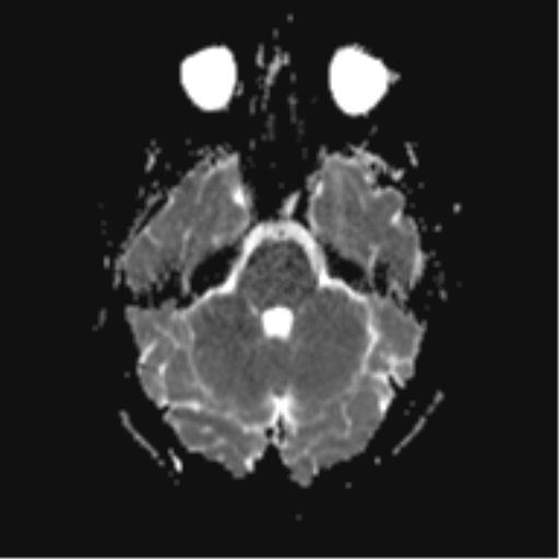 File:Cerebral cavernoma and development venous anomaly (Radiopaedia 37603-39482 Axial ADC 7).png