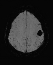 Cerebral cavernous venous malformation (Radiopaedia 70008-80021 Axial SWI 51).jpg