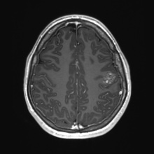 Cerebral cavernous venous malformation (Radiopaedia 70008-80021 Axial T1 C+ 68).jpg