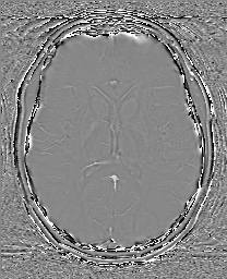 Cerebral cavernous venous malformation (Radiopaedia 70008-80021 G 41).jpg