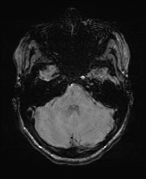 Cerebral cavernous venous malformation (Radiopaedia 70008-80021 I 17).jpg