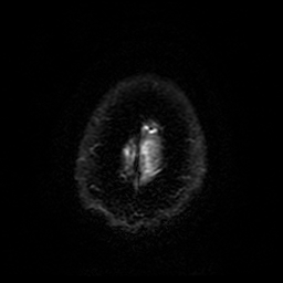 Cerebral cavernous venous malformation (Zabramski type II) (Radiopaedia 85511-101198 Axial DWI 96).jpg