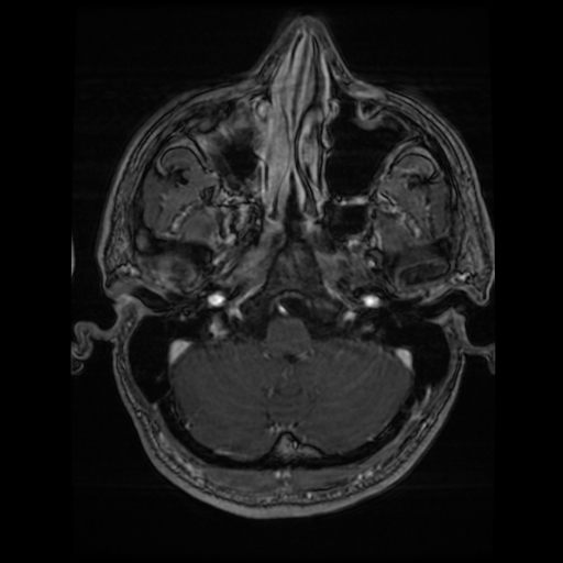 Cerebral cavernous venous malformation (Zabramski type II) (Radiopaedia 85511-101198 Axial T1 C+ fat sat 69).jpg