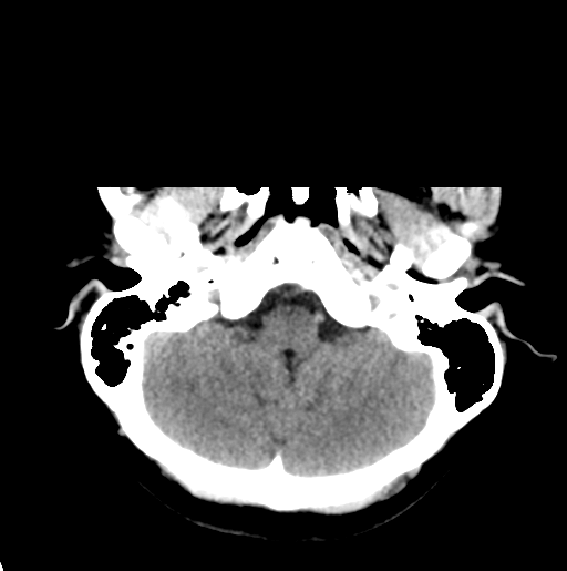 File:Cerebral cavernous venous malformations (Radiopaedia 48117-52945 Axial non-contrast 7).png