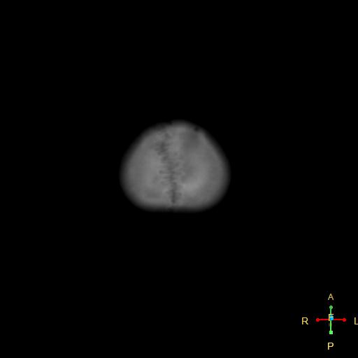 File:Cerebral contusion (Radiopaedia 48869-53911 Axial bone window 1).jpg