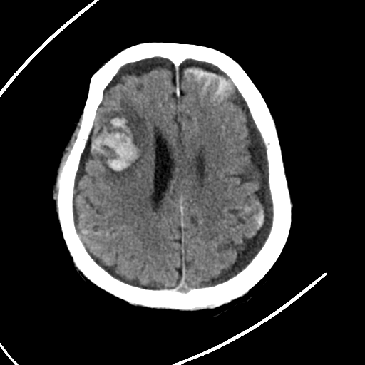 File:Cerebral contusions, subarachnoid hemorrhage and subdural hygromas (Radiopaedia 55399-61830 Axial non-contrast 21).png