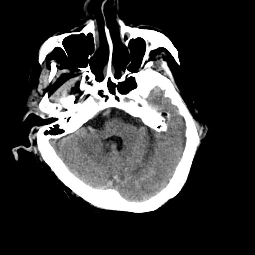 File:Cerebral contusions, subarachnoid hemorrhage and subdural hygromas (Radiopaedia 55399-61830 Axial non-contrast 8).png