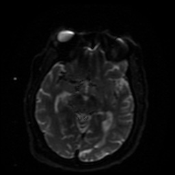 Cerebral embolic infarcts (embolic shower) (Radiopaedia 49837-55108 Axial DWI 28).jpg
