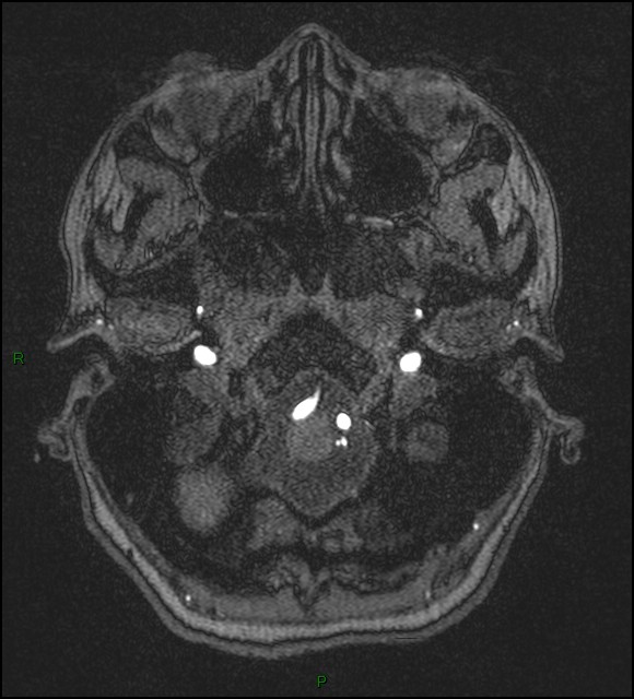 Cerebral fat embolism (Radiopaedia 35022-36525 Axial TOF 18).jpg