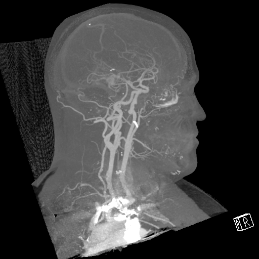 File:Cerebral hemorrhage secondary to arteriovenous malformation (Radiopaedia 33497-34571 A 31).png