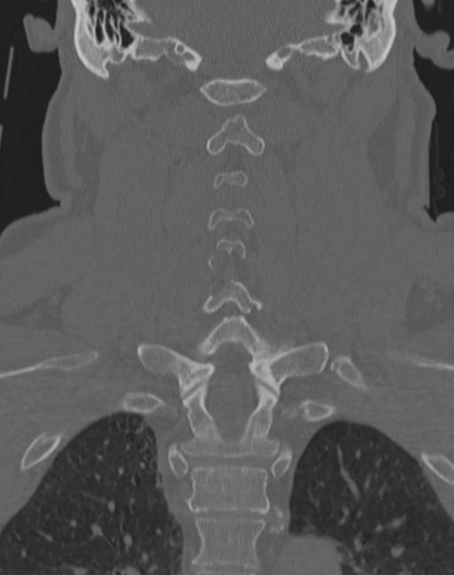 Cerebral hemorrhagic contusions and cervical spine fractures (Radiopaedia 32865-33841 Coronal bone window 46).jpg