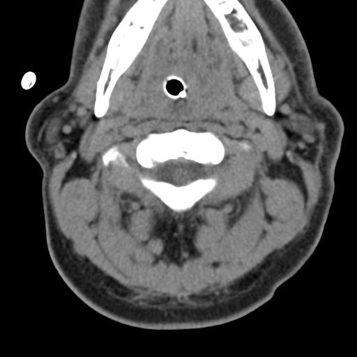 Cerebral hemorrhagic contusions and cervical spine fractures (Radiopaedia 32865-33841 F 16).jpg