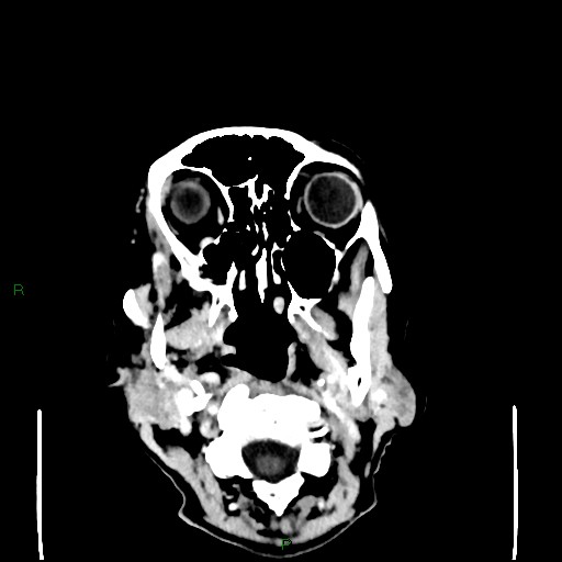 Cerebral metastases - breast primary (Radiopaedia 77653-89857 Axial C+ delayed 5).jpg