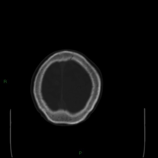 Cerebral metastases - breast primary (Radiopaedia 77653-89857 Axial bone window 105).jpg