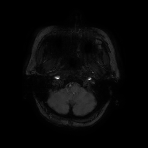 Cerebral metastases - melanoma (Radiopaedia 80972-94522 Axial SWI 13).jpg
