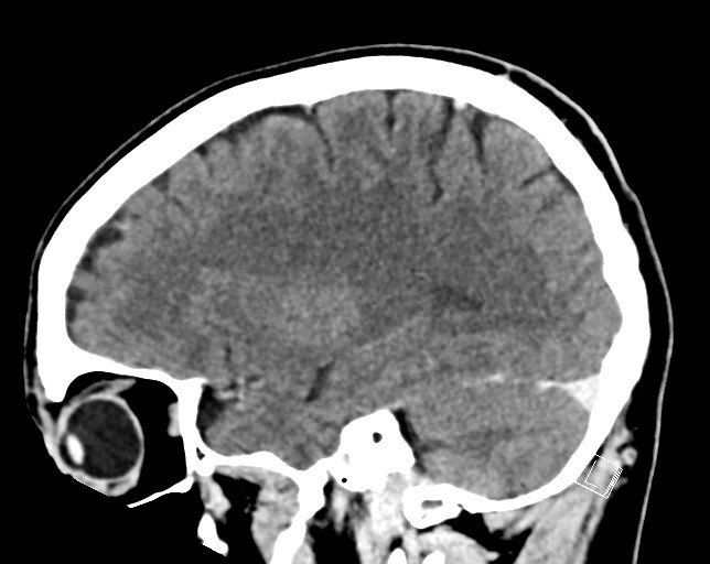 Cerebral metastases - testicular choriocarcinoma (Radiopaedia 84486-99855 F 40).jpg