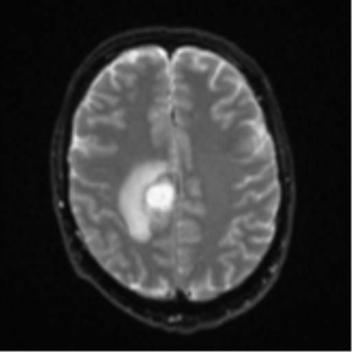 Cerebral metastasis - colorectal adenocarcinoma (Radiopaedia 50394-55765 Axial DWI 19).png