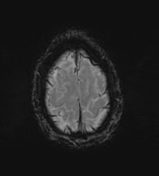 Cerebral metastasis - melanoma (Radiopaedia 54718-60954 Axial SWI 51).png