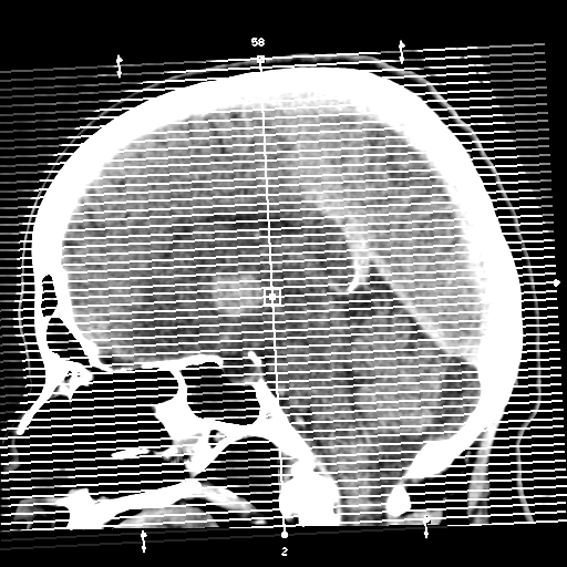 Cerebral metastasis to basal ganglia (Radiopaedia 81568-95412 Axial C+ delayed 1).png