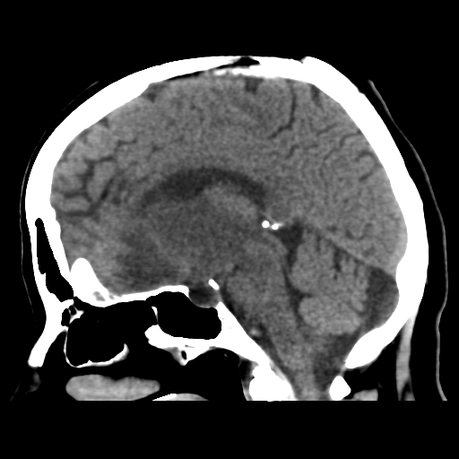 Cerebral metastasis to basal ganglia (Radiopaedia 81568-95412 E 32).png