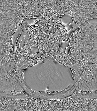 Cerebral metastasis to basal ganglia (Radiopaedia 81568-95413 Axial SWI phase 15).png