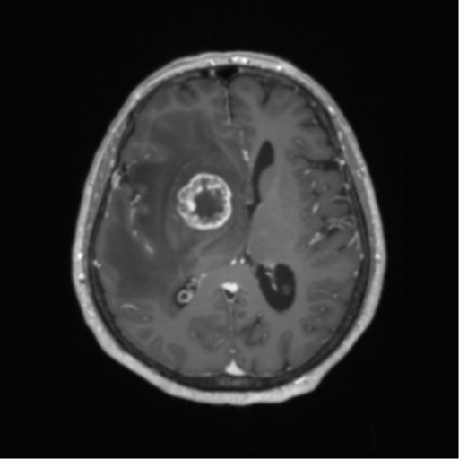 Cerebral metastasis to basal ganglia (Radiopaedia 81568-95413 Axial T1 C+ 39).png
