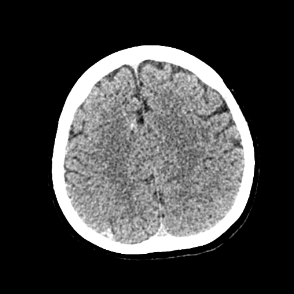 File:Cerebral ring enhancing lesions - cerebral metastases (Radiopaedia 44922-48818 Axial non-contrast 74).jpg