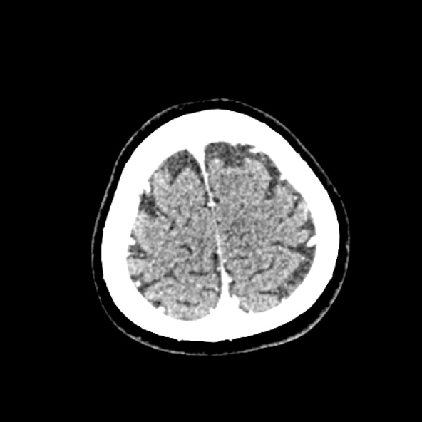 Cerebral ring enhancing lesions - cerebral metastases (Radiopaedia 44922-48818 B 252).jpg