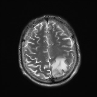 File:Cerebral toxoplasmosis (Radiopaedia 43956-47461 Axial T2 18).jpg