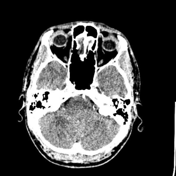 File:Cerebral toxoplasmosis (Radiopaedia 53993-60131 Axial C+ delayed 17).jpg