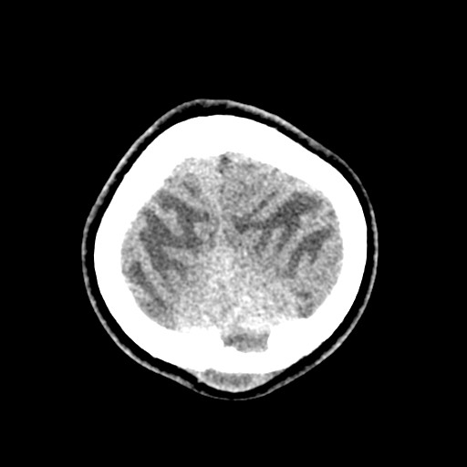 Cerebral tuberculosis with dural sinus invasion (Radiopaedia 60353-68018 Axial non-contrast 57).jpg