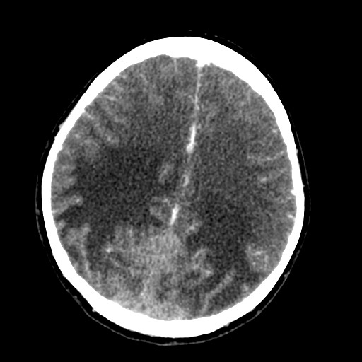 Cerebral tuberculosis with dural sinus invasion (Radiopaedia 60353-68019 Axial C+ delayed 44).jpg