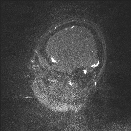 Cerebral tuberculosis with dural sinus invasion (Radiopaedia 60353-68090 Sagittal MRV 135).jpg