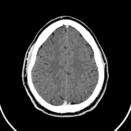 File:Cerebral venous angioma (Radiopaedia 69959-79977 B 80).jpg